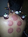 Una persona recibiendo terapia de ventosas húmedas hijama