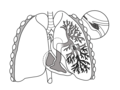 Thumbnail for Pulmonary embolism