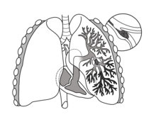 Tromboembolismo pulmonar