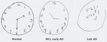 Links: Uhrenzeichnung einer gesunden Kontrollperson Mitte: Betroffene in der Frühphase. Die Grundstruktur der Uhr ist noch zu erkennen, die Stunden jedoch nicht mehr gleichmäßig verteilt. Rechts: Verworrenes Bild, der äußere Ring der Uhr ist nicht mehr geschlossen, die Zahlen wahllos in der Mitte des Ziffernblatts positioniert.