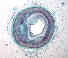 Atherosklerose, Histologie.