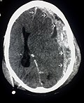 Vorschaubild für Schädel-Hirn-Trauma