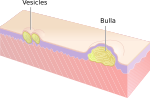 Thumbnail for Vesiculobullous disease